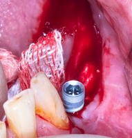 RBB 05. Операция установки имплантатов в новую кость