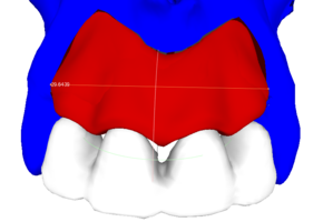 RBB 07. Модель челюсти, модель блока, встречные зубы