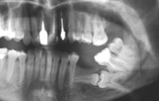 Биоимплантаты Лиопласт при удалении зубов. Видео операции №1